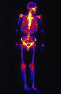 Medical Imaging Techniques Imprime: Normal Bone Scan
