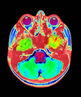 Normal Brain Anatomy Imprime: Normal MRI