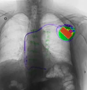 Human Anatomy Imprime: Pacemaker